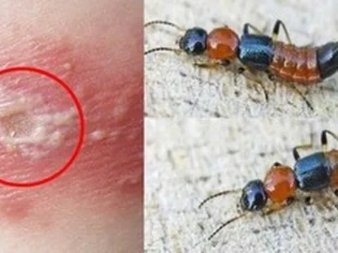 Những sai lầm phổ biến khi nhầm viêm da do kiến ba khoang với bệnh zona thần kinh