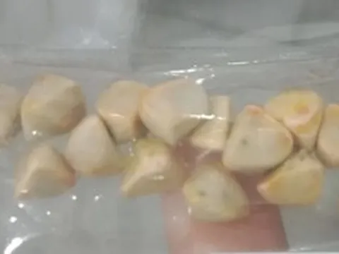 Uống trà đá đều đặn suốt 10 năm, người phụ nữ sốc khi bác sĩ lấy ra thứ "đáng sợ" trong bụng