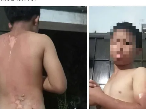 Công an vào cuộc vụ mẹ tạt nước sôi lên người con trai