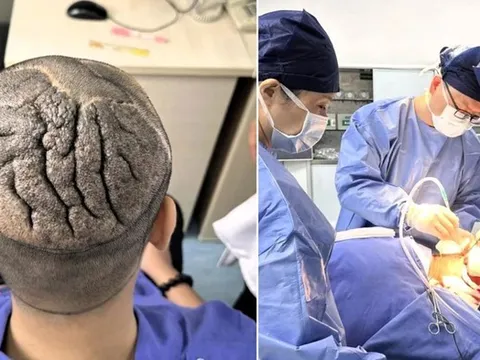 Người đàn ông 23 tuổi có da đầu dày, gấp nếp như bộ não và sự thật bất ngờ