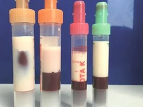 Cô gái 23 tuổi có máu "trắng đục như sữa" vì thói quen tưởng tốt