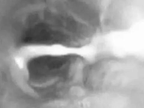 Bé trai 3 tuổi ho suốt 1 tháng, gia đình sửng sốt khi biết lý do