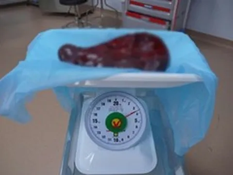 Bụng người đàn ông 69 tuổi ngày càng phình to, bác sĩ sững sờ khi phát hiện thứ "khổng lồ" bên trong