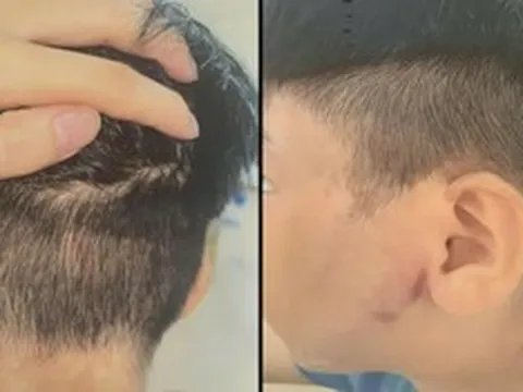 Triệu tập người cha vụ bé trai 8 tuổi nghi bị bạo hành phải nhập viện cấp cứu