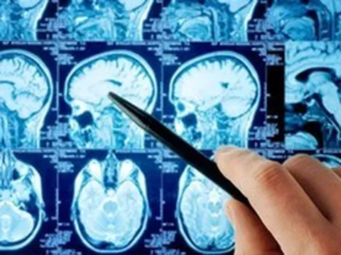 Từ ca đột quỵ ở tuổi 33: Vì sao người trẻ ngày càng đối mặt với “cơn ác mộng” này?