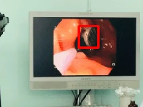 Ngậm đinh trong miệng, người đàn ông 50 tuổi gặp sự cố đáng sợ