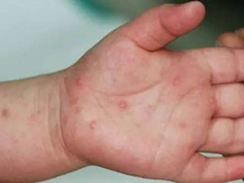 Ghi nhận 3.000 ca mắc tay chân miệng mỗi tuần, Bộ Y tế khuyến cáo khẩn