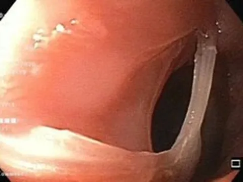 Cụ ông 81 tuổi suýt gặp nguy vì xương ghẹ mắc kẹt trong thực quản