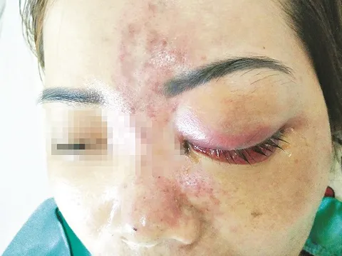 Tiêm Filler có thật sự an toàn?